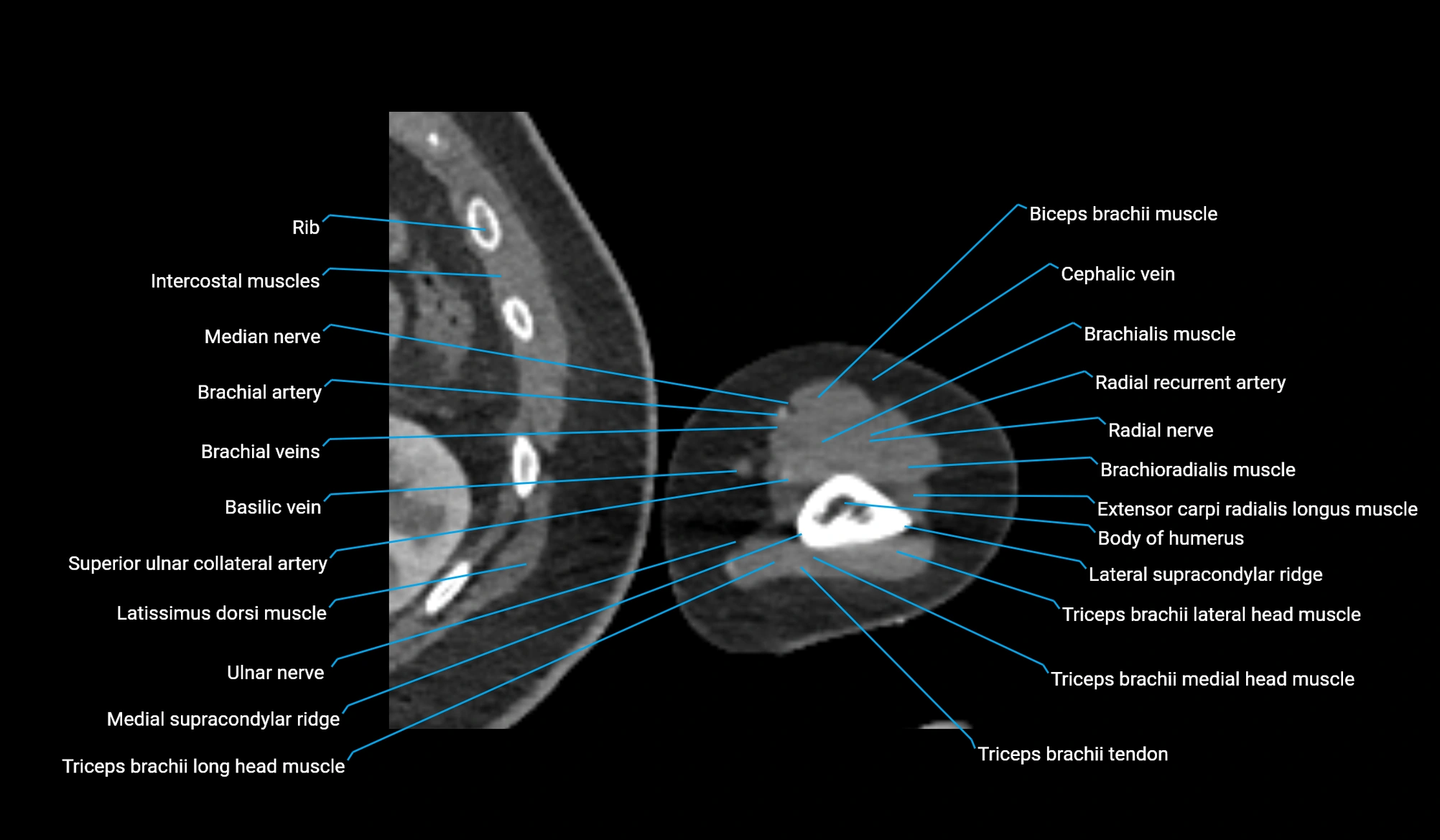 CT upper arm axial  cross sectional anatomy labelled radiology image -00348.webp